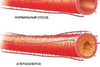 Как укрепить сосуды